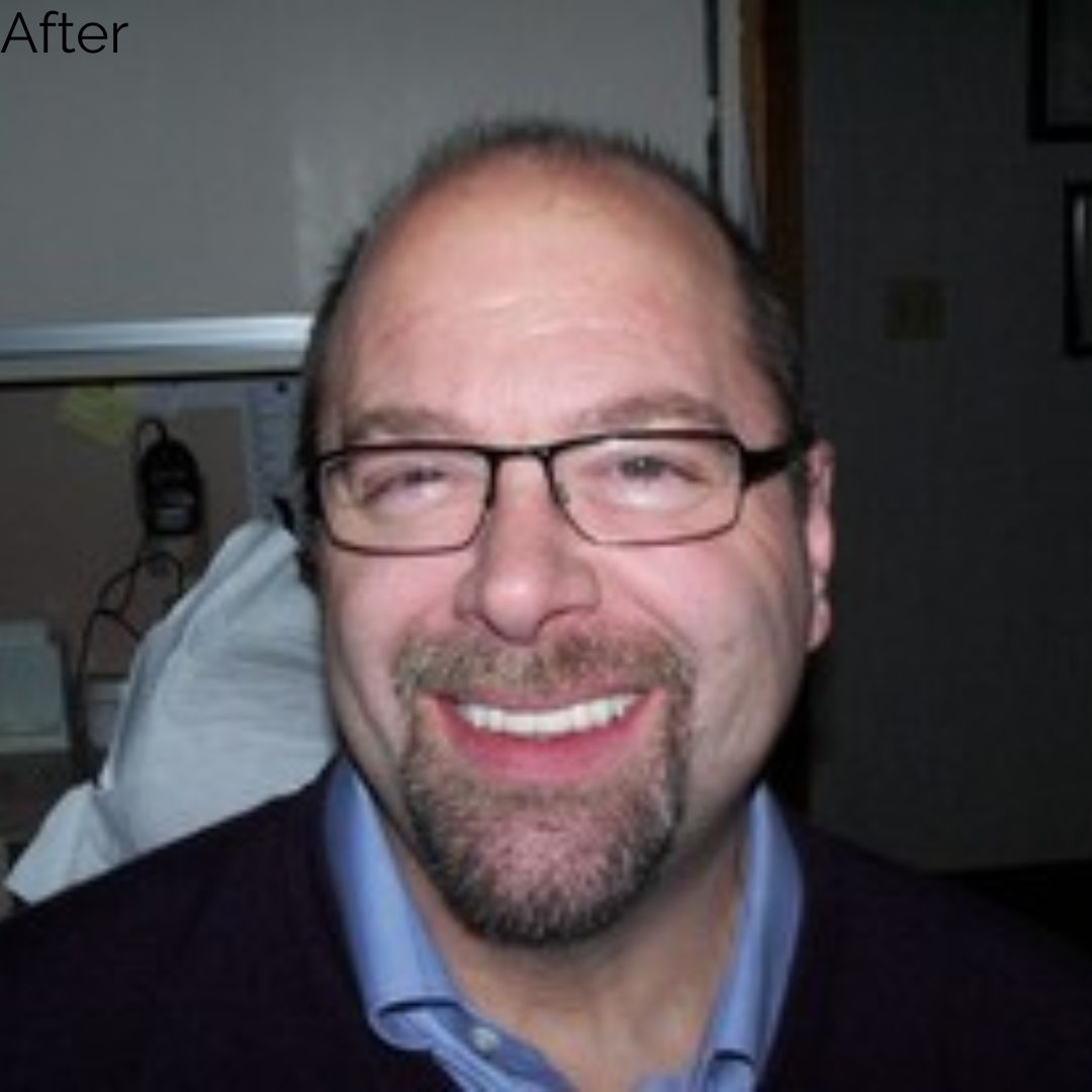 After treatment at Summit Dental Group