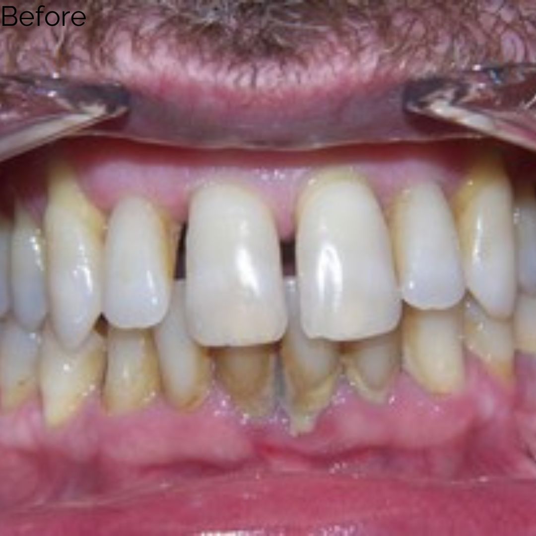 Before treatment at Summit Dental Group