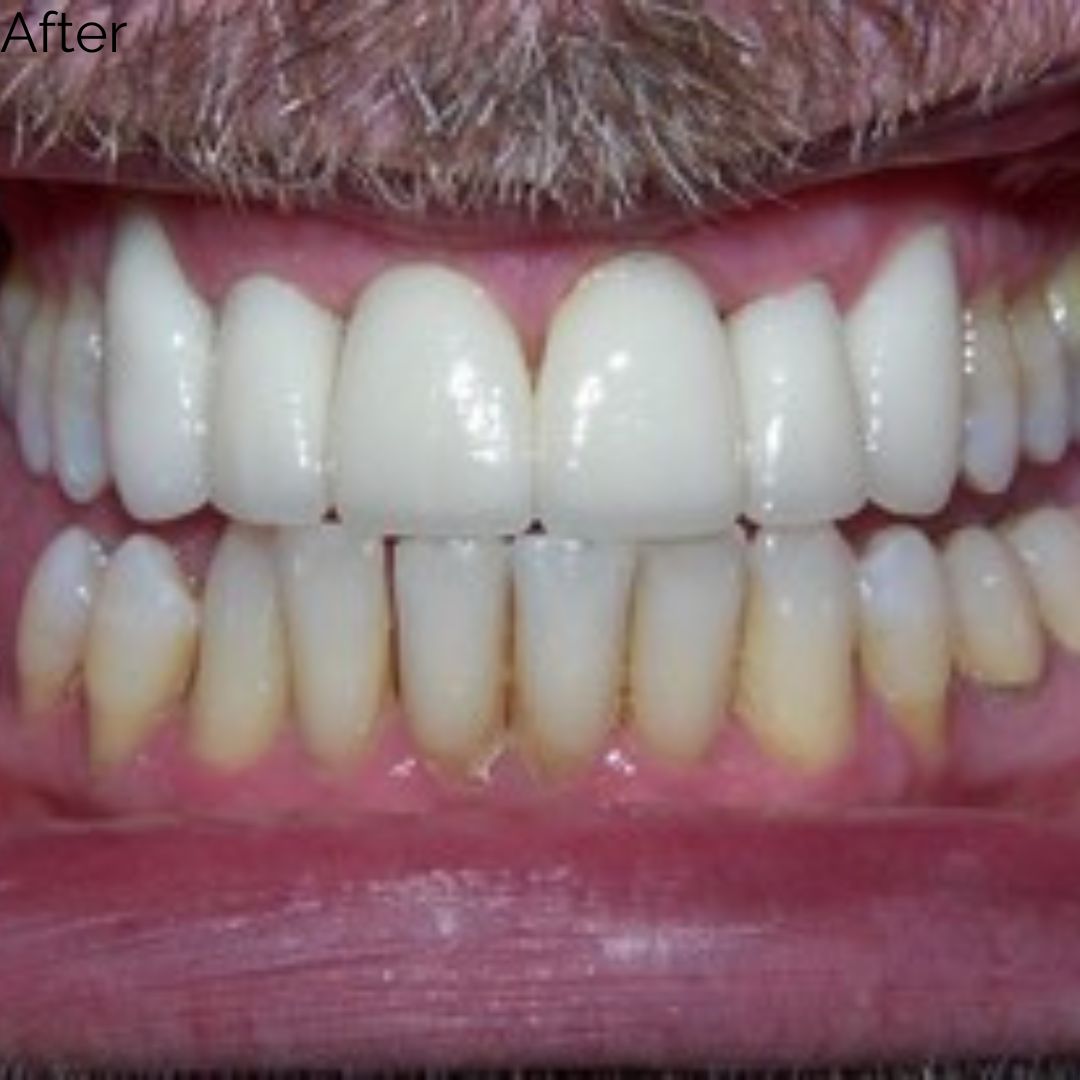 After treatment at Summit Dental Group