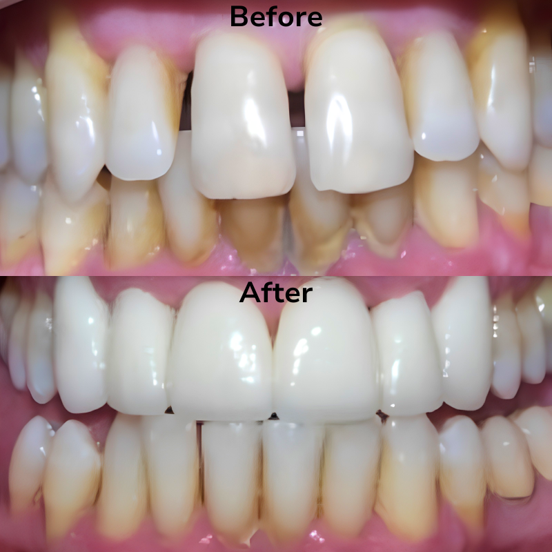 Summit dental before and afters (1)