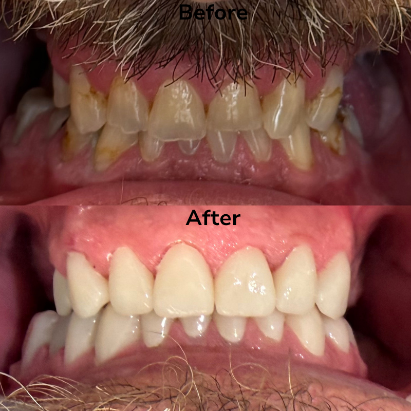 Clear Aligners before and after